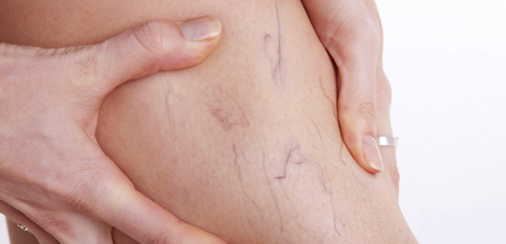 درمان واریس