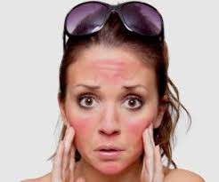 افتاب سوختگی در طب سنتی