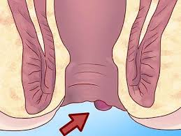 درمان بواسیر در طب سنتی