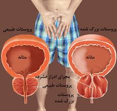 درمان بزرگی غده پروستات