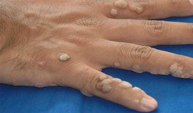 درمان زگیل در طب سنتی