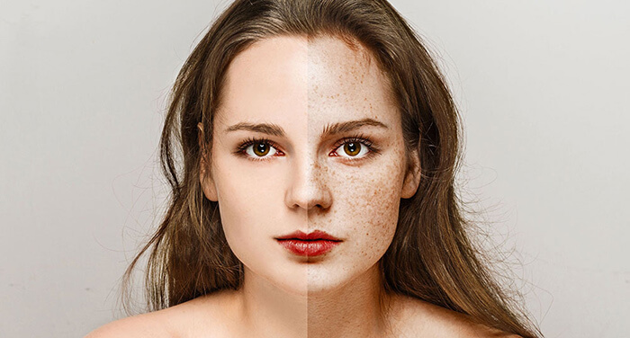 درمان و رفع کک و مک با روش‌های طب سنتی