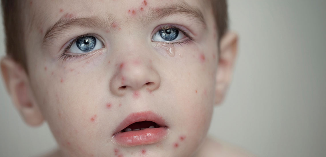 درمان آبله مرغان