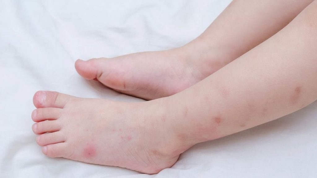 درمان گزیدگی حشرات با روش‌های طب سنتی