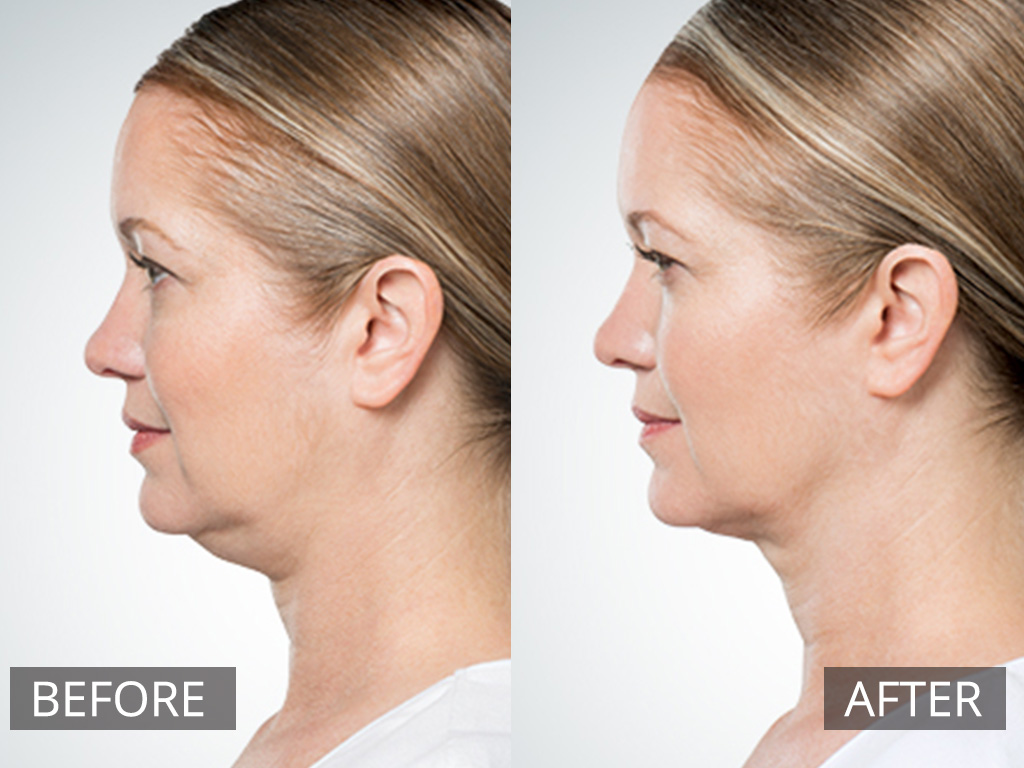 رفع و از بین بردن غبغب با روش‌های طب سنتی