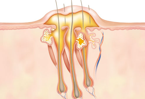 درمان کورک با روش‌های طب سنتی