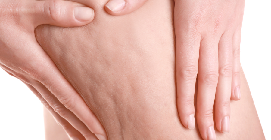 درمان سلولیت با روش‌های طب سنتی