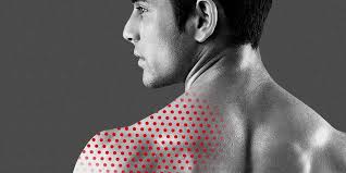 رفع جوش‌های ناحیه شانه و کمر با استفاده از روش‌های طب سنتی