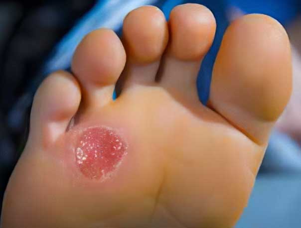 درمان زخم پای دیابتی