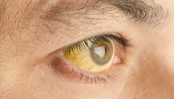 درمان یرقان