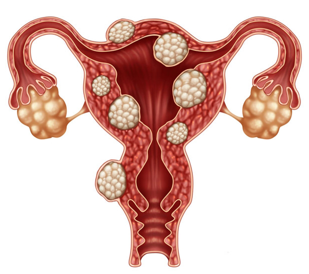  فیبروم رحم و درمان آن با طب سنتی