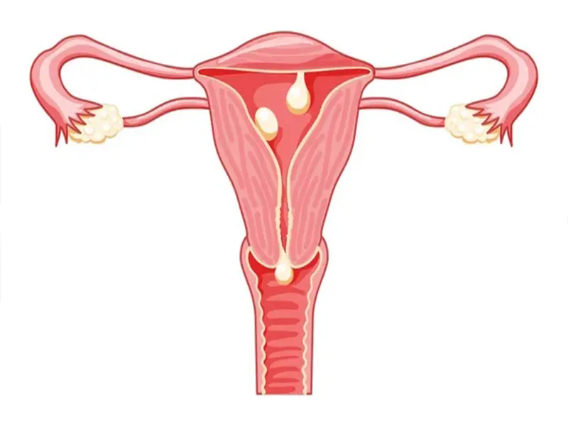  درمان پولیپ رحم با طب سنتی